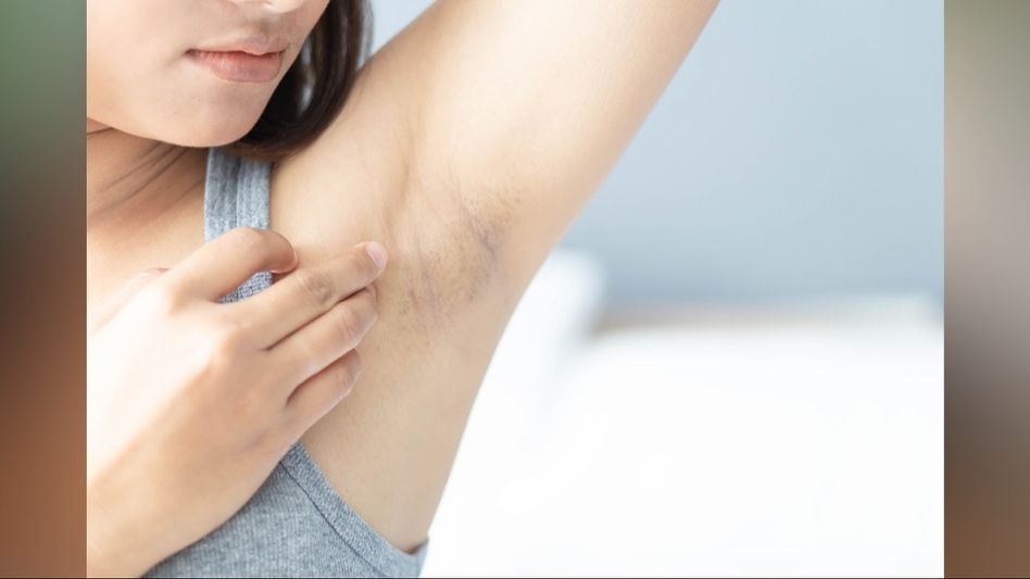 Brighten Up: Home Remedies for Treating Dark Underarms and Boosting Confidence Brighten Up: Home Remedies for Treating Dark Underarms and Boosting Confidence