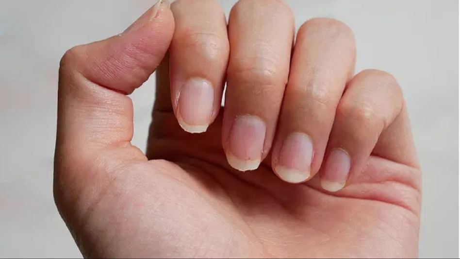 Nurturing Nature's Gift: Home Remedies for Treating Brittle Nails Nurturing Nature's Gift: Home Remedies for Treating Brittle Nails