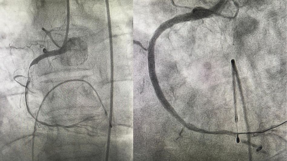 Arunachal's TRIHMS performs state's first successful primary angioplasty Arunachal's TRIHMS performs state's first successful primary angioplasty