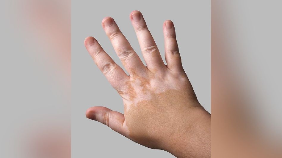 Tackling Vitiligo with Home Remedies: A Comprehensive Guide Tackling Vitiligo with Home Remedies: A Comprehensive Guide