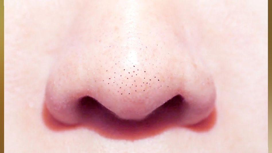Beat the Summer Heat: Effective Ways to Clear Excess Oil Around the Nose Region Beat the Summer Heat: Effective Ways to Clear Excess Oil Around the Nose Region