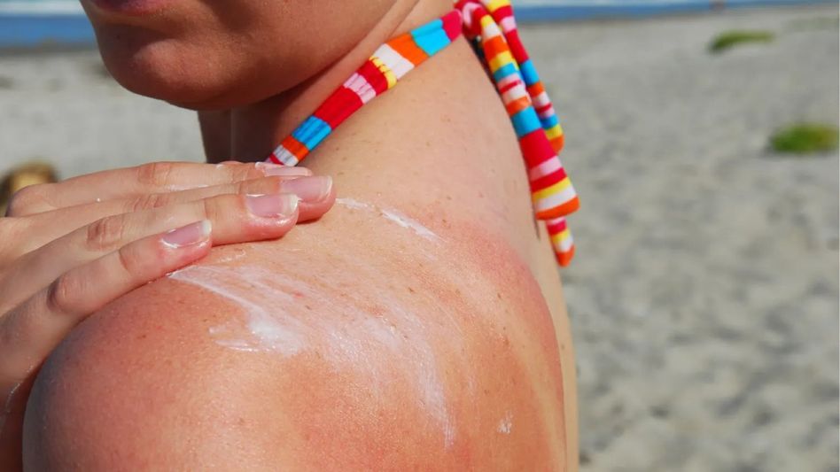 Effective Home Remedies for Treating Sunburn: Tips and Tricks Effective Home Remedies for Treating Sunburn: Tips and Tricks