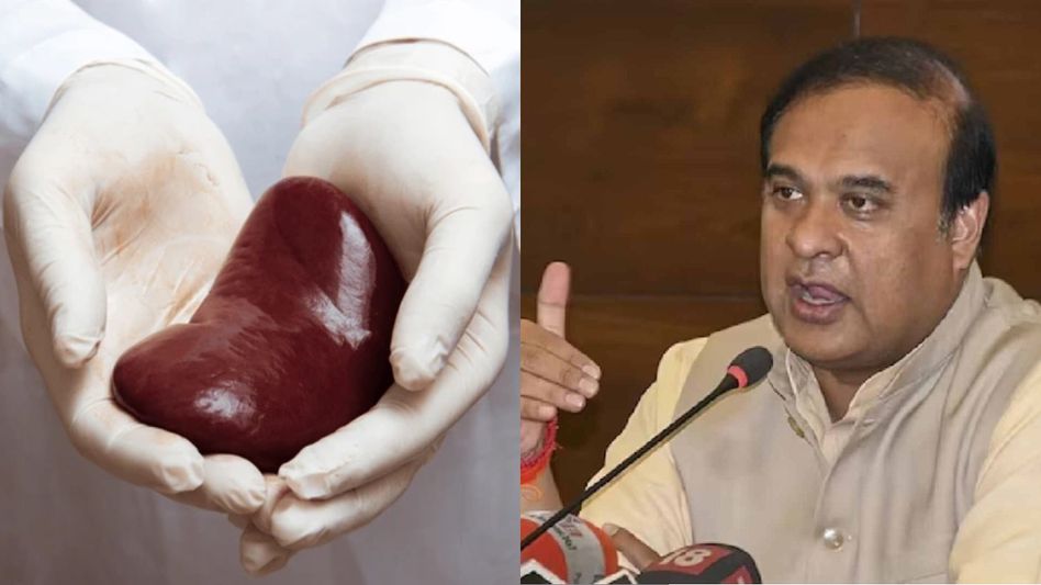 First successful cadaver kidney transplant performed at GMCH: Himanta Biswa Sarma First successful cadaver kidney transplant performed at GMCH: Himanta Biswa Sarma