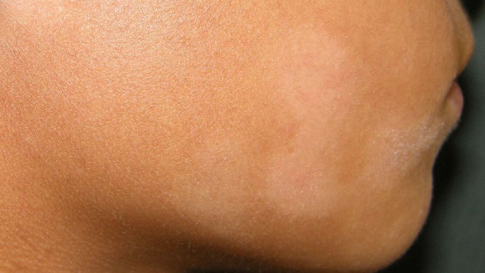 Natural Remedies for White Patches on the Face: Home Treatments and Tips Natural Remedies for White Patches on the Face: Home Treatments and Tips