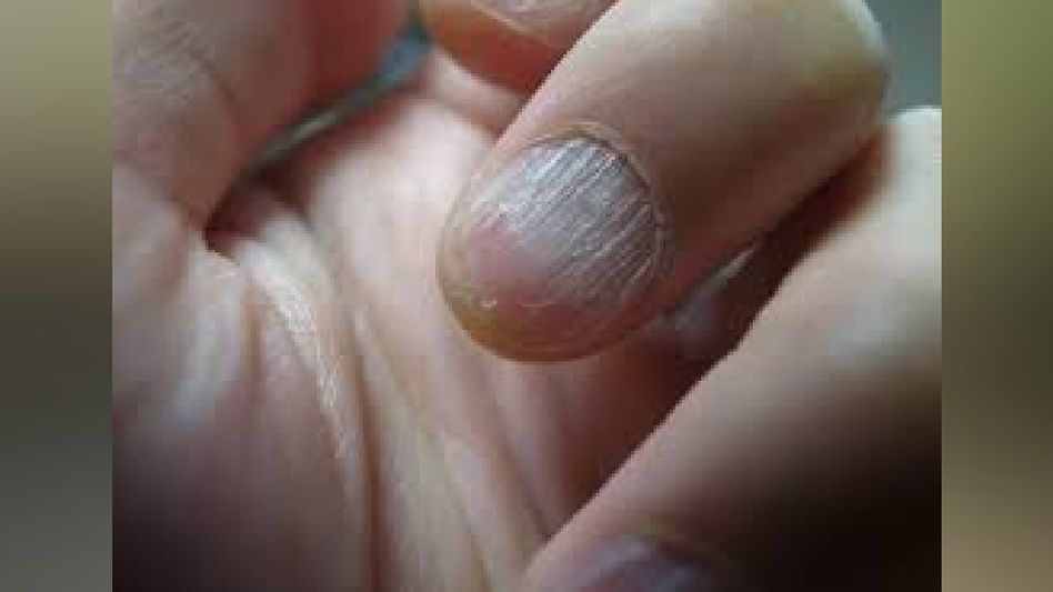 Effective Home Remedies to Combat White Chapped Nails Effective Home Remedies to Combat White Chapped Nails