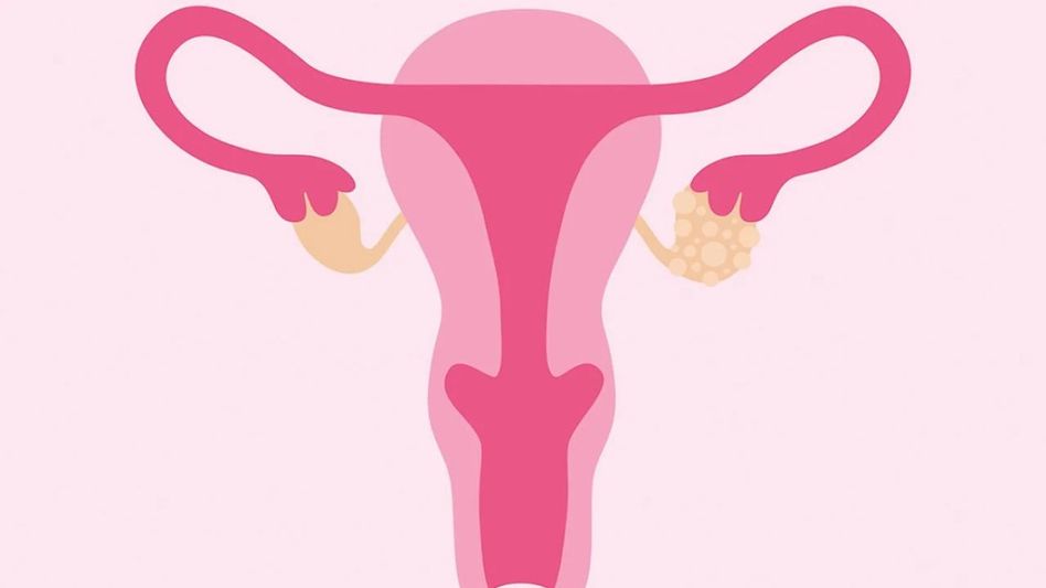 How does PCOS affects your chances of pregnancy? How does PCOS affects your chances of pregnancy?