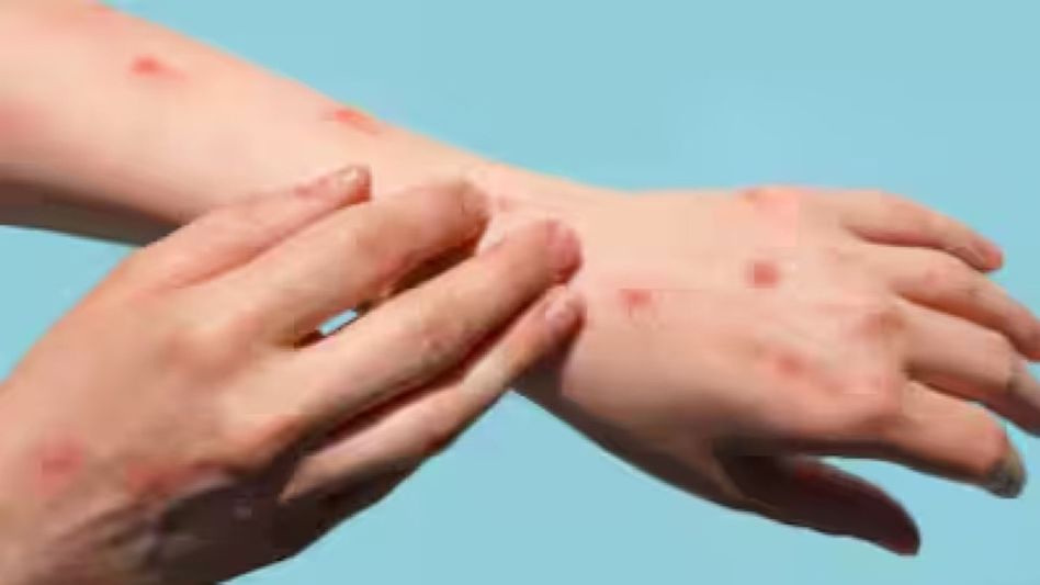 Meghalaya issues health advisory amid global monkeypox concerns Meghalaya issues health advisory amid global monkeypox concerns