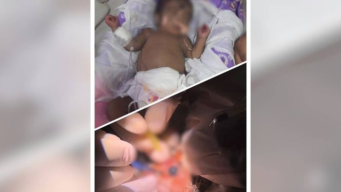 Arunachal: TRIHMS successfully treats baby girl with Retinopathy of Prematurity