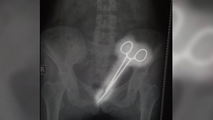 Sikkim: STNM hospital alleged of negligence; forceps left in woman's abdomen removed 12 years later