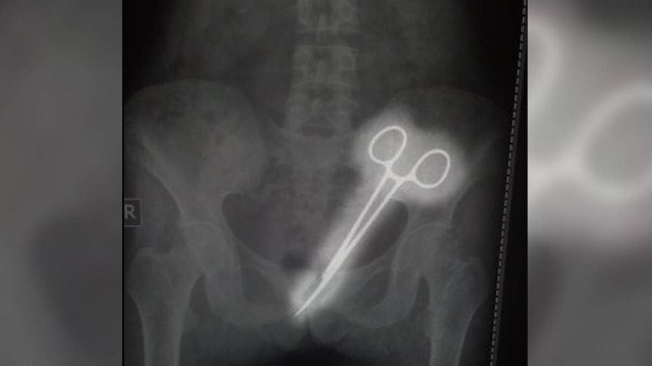 Sikkim: STNM hospital alleged of negligence; forceps left in woman's abdomen removed 12 years later Sikkim: STNM hospital alleged of negligence; forceps left in woman's abdomen removed 12 years later