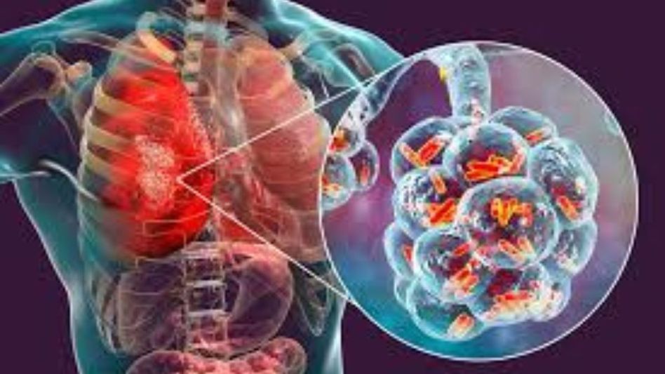 147 people died due to tuberculosis in Mizoram since January 2024 147 people died due to tuberculosis in Mizoram since January 2024