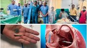 Tripura’s GBP hospital performs first leadless pacemaker implantation Tripura’s GBP hospital performs first leadless pacemaker implantation