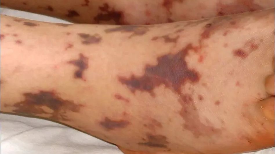 Meghalaya issues health advisory after suspected meningococcal infection cases in Shillong Meghalaya issues health advisory after suspected meningococcal infection cases in Shillong