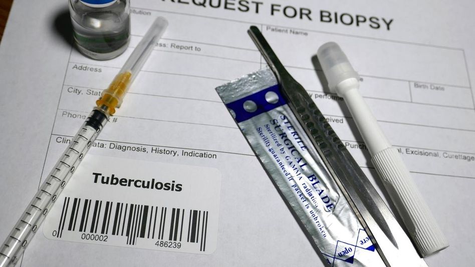 Mizoram reports 145 TB deaths, 2,275 cases; push for TB-free villages gains momentum Mizoram reports 145 TB deaths, 2,275 cases; push for TB-free villages gains momentum