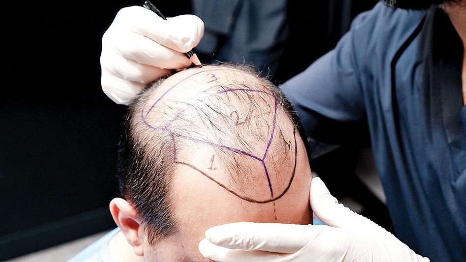 Pakistani Lashkar operative arrested in J&K after entering India for hair transplant: Officials Pakistani Lashkar operative arrested in J&K after entering India for hair transplant: Officials