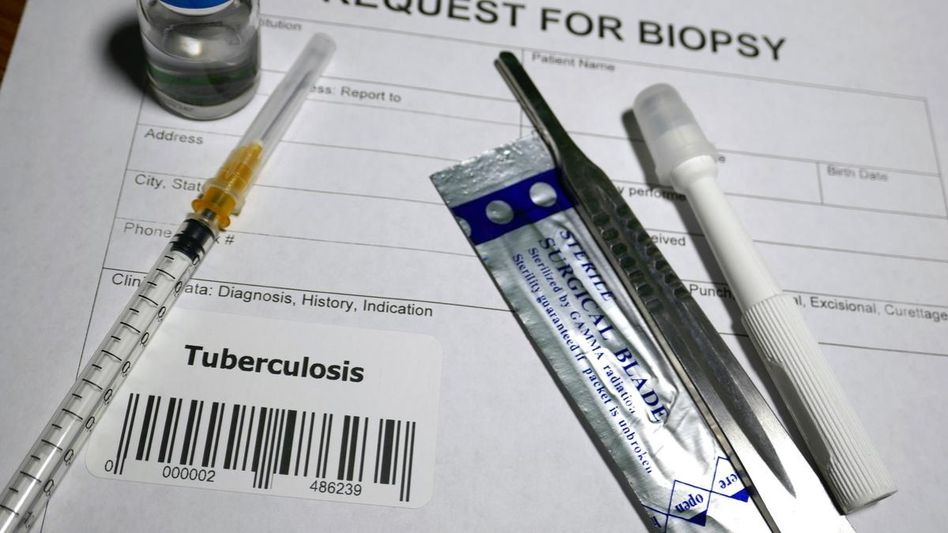 Mizoram records 71 TB deaths, over 1,000 new cases in first half of 2026 Mizoram records 71 TB deaths, over 1,000 new cases in first half of 2026