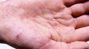 Nagaland issues meningococcal disease alert after 14-year-old boy hospitalised Nagaland issues meningococcal disease alert after 14-year-old boy hospitalised
