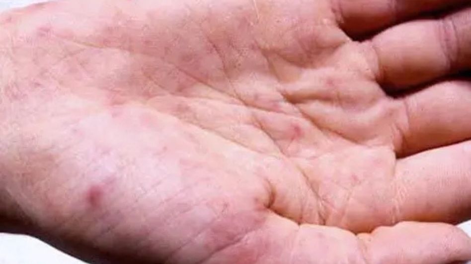 Nagaland issues meningococcal disease alert after 14-year-old boy hospitalised Nagaland issues meningococcal disease alert after 14-year-old boy hospitalised