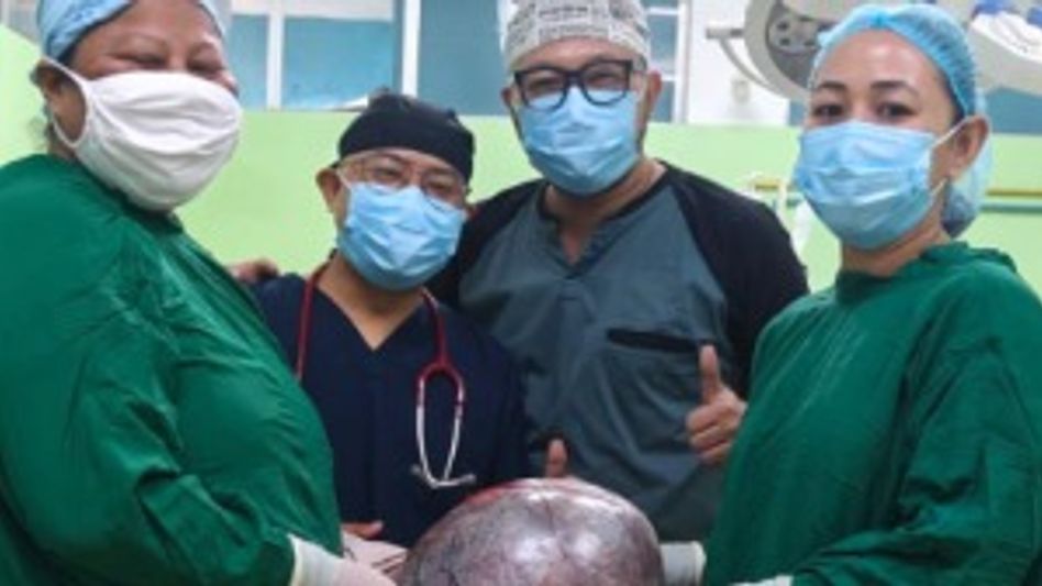15-kg ovarian tumour removed in first-of-its-kind surgery at Meghalaya's Williamnagar Civil Hospital 15-kg ovarian tumour removed in first-of-its-kind surgery at Meghalaya's Williamnagar Civil Hospital