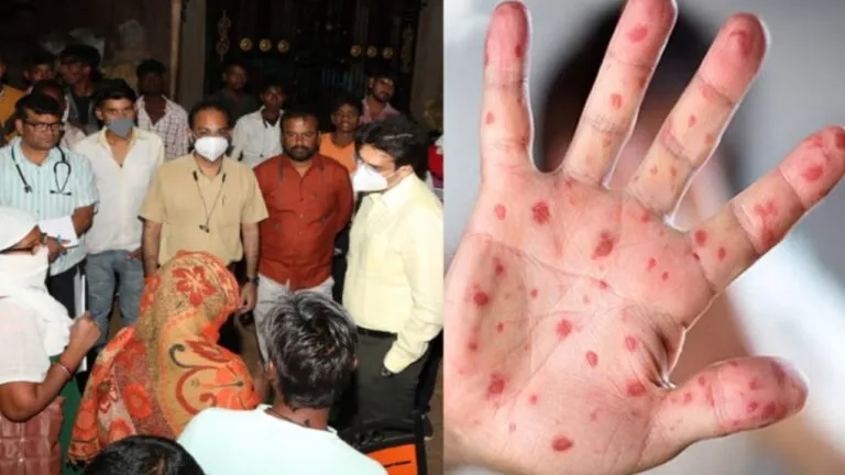 measles virus Outbreak of measles and chicken pox in Katni, death of one and a half year old innocent, many villages in grip