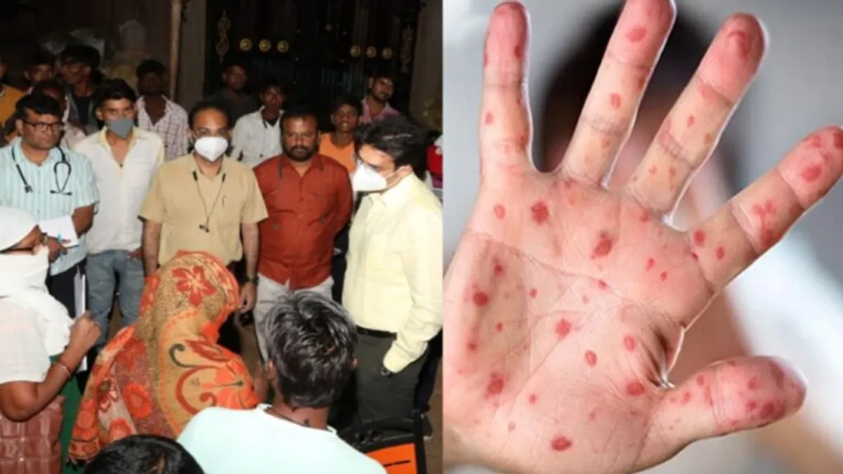 कटनी में मीजल्स और चिकन पॉक्स का बरपा प्रकोप, डेढ़ साल के मासूम की मौत, चपेट में कई गांव measles virus Outbreak of measles and chicken pox in Katni, death of one and a half year old innocent, many villages in grip
