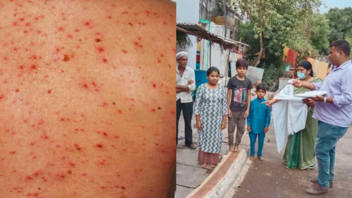 नरसिंहपुर में चिकन पॉक्स का कहर, स्वास्थ्य विभाग की टीमें कर रहीं घर घर जाकर जांच Chicken pox wreaks havoc in Narsimpur, health department teams are doing door to door investigation
