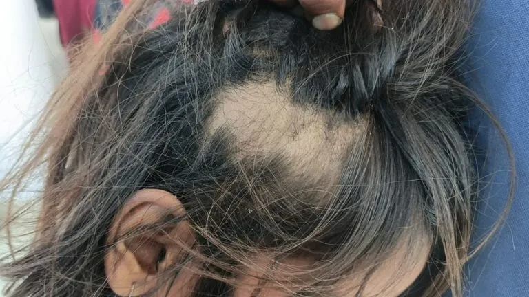 When a fourth class student could not read English, the cruel teacher pulled out her hair