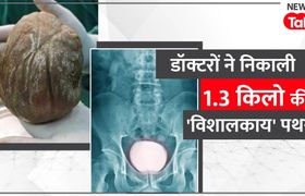 Medical Miracle: पेशाब में दर्द से 3 साल तक तड़पता रहा शख्स, डॉक्टरों ने पेट से निकाली 1.3 किलो की 'विशालकाय' पथरी, उड़े सबके होश NewsTak