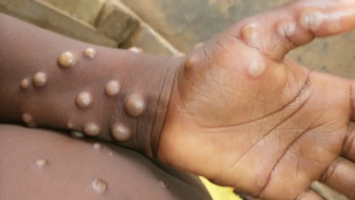 Monkey Pox (Photo: WHO)
