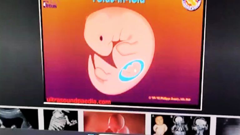 MP में चमत्कार: 3 दिन पहले जन्मे बच्चे के पेट में बच्चा, डॉक्टर बोले- जिंदगी में पहली बार देखा ऐसा केस mp_news