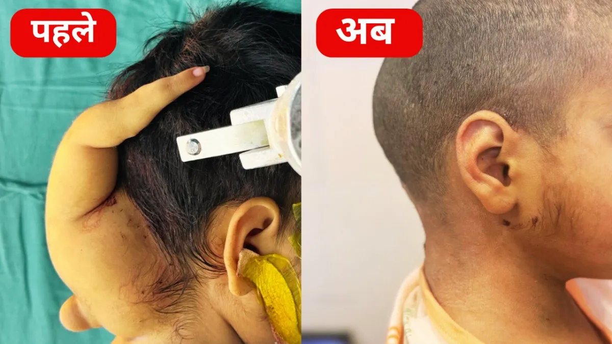 भोपाल एम्स के डॉक्टरों ने चमत्कार करते हुए एक बच्ची के सिर का सफलता पूर्वक ऑपरेशन किया है