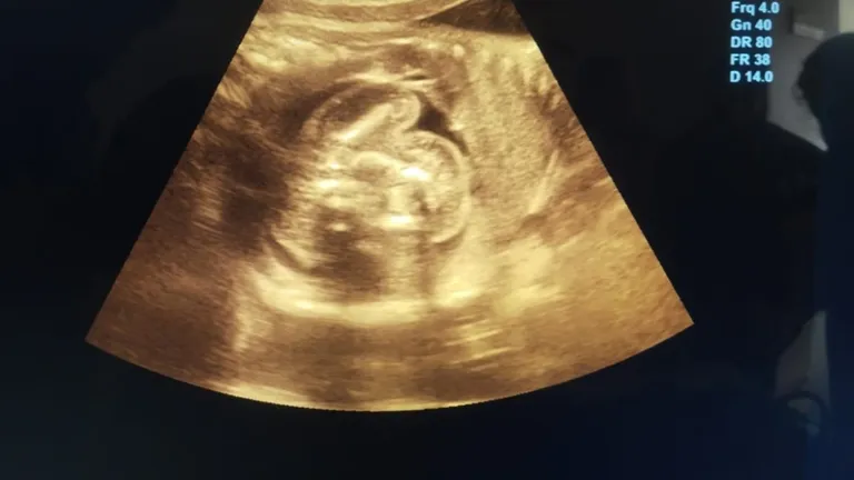 बुलंदशहर में महिला के गर्भाशय की जगह लीवर में पल रहा था बच्चा ,जांच हुई तो डॉक्टरों के उड़े होश NewsTak