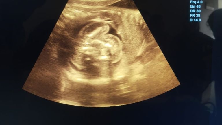 बुलंदशहर में महिला के गर्भाशय की जगह लीवर में पल रहा था बच्चा ,जांच हुई तो डॉक्टरों के उड़े होश NewsTak