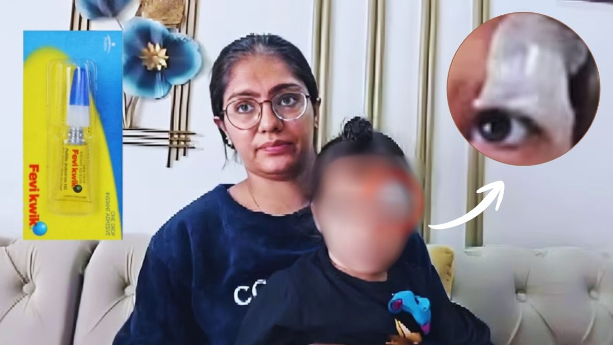 मेरठ में डॉक्टर की बड़ी लापरवाही! बच्चे के आंख के पास लगी थी चोट...टांके की जगह घाव पर लगा दिया फेविक्विक! CMO ने बैठाई जांच UP News