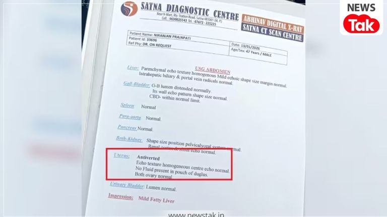 सतना में BJP नेता की जांच रिपोर्ट ने उड़ाए होश, पुरूष के पेट में निकला उल्टा गर्भाशय! फिर पता चली पूरी बात सतना में अजब गजब मामला