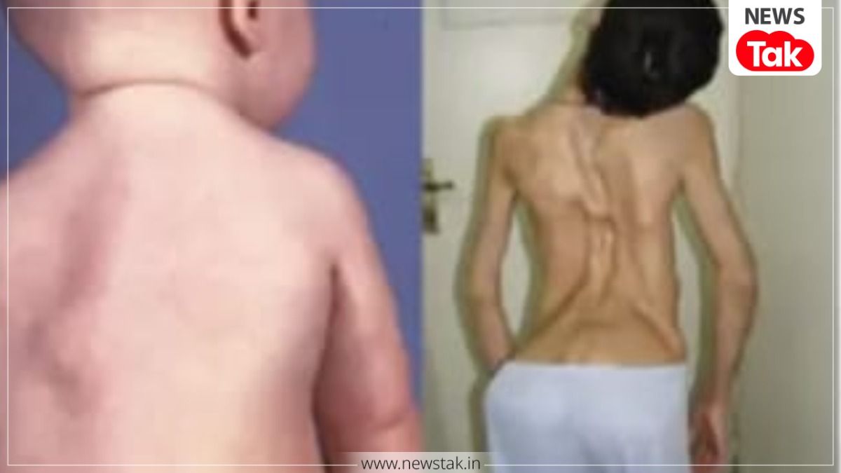 जैसलमेर में 'स्टोन मैन सिंड्रोम' की दस्तक: 9 साल का बच्चा धीरे-धीरे बन रहा पत्थर, शरीर की मांसपेशियां बन रहीं हड्डी jaisalmer