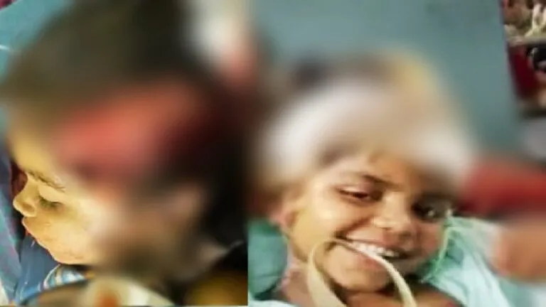 कोटाः थ्रेसर की चपेट में आ गई 6 साल की बच्ची, ब्रेन का हिस्सा नष्ट, डॉक्टर्स ने जटिल ऑपरेशन को दिया