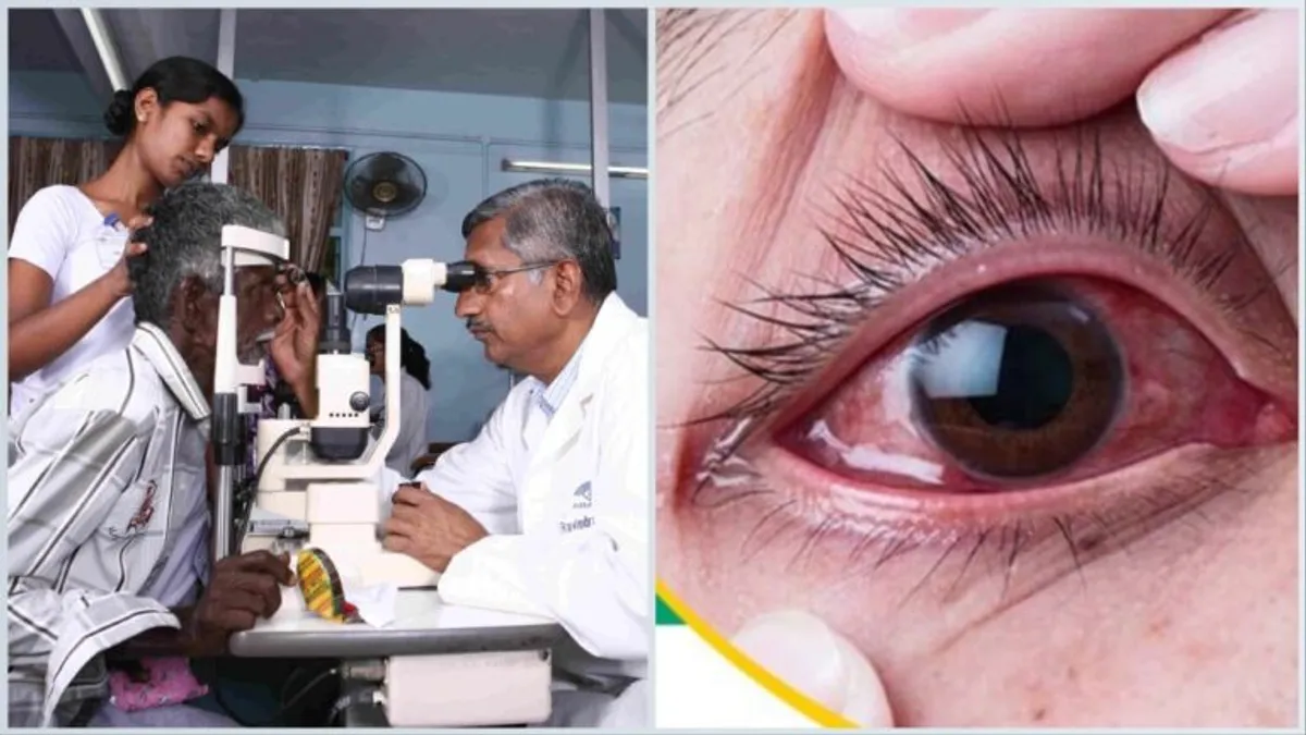 Conjunctivitis: राजस्थान में बढ़ रहे कंजंक्टिवाइटिस के मामले, जानें इसके कारण और बचाव के तरीके Conjunctivitis: राजस्थान में बढ़ रहे कंजंक्टिवाइटिस के मामले, जाने इसके कारण और बचाव के तरीके