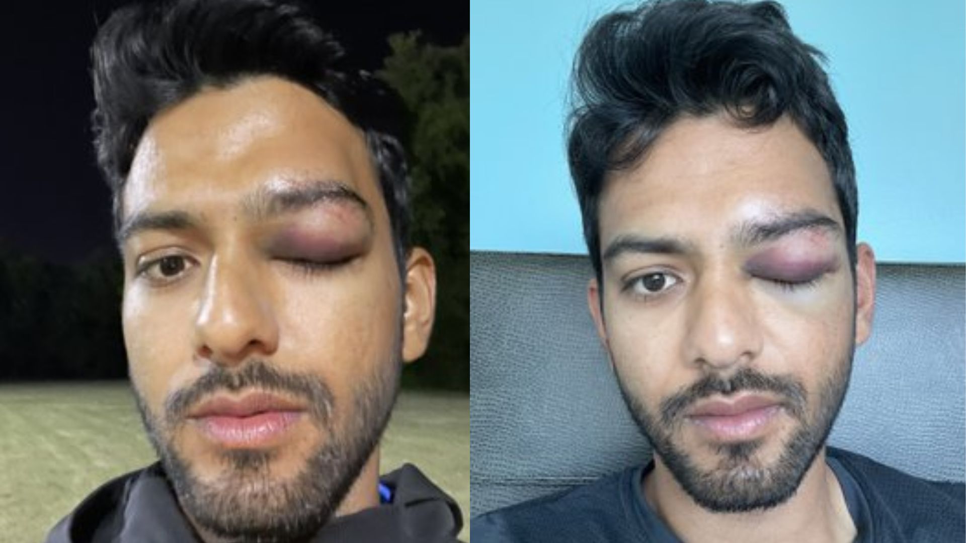 उन्मुक्त चंद को आंख पर लगी गंभीर चोट, सामने आई फोटोज, बोले- दुर्घटना से बच गया