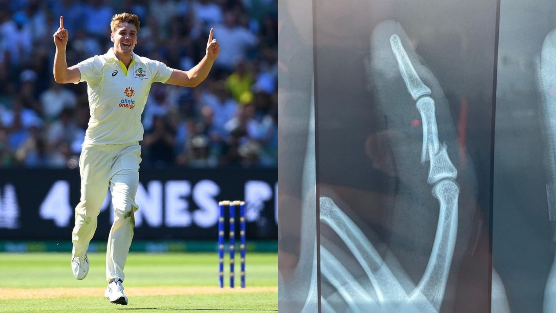 AUS vs SA: ऑस्ट्रेलियाई बल्लेबाज ने नहीं मानी हार, टूटी अंगुली से खेल गया 157 गेंद, सामने आया डरावना एक्सरे