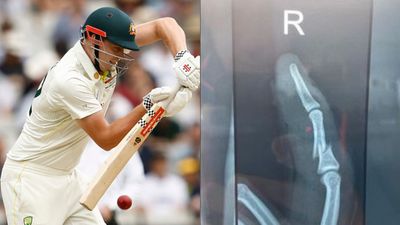 AUS vs SA: Australian all-rounder Cameron Green shares X-ray image of fractured finger after fighting his way to 50 SportsTak