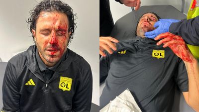 Ligue 1: Lyon manager Fabio Grosso grievously injured after team bus pelted with rocks before Marseilles clash Lyon manager Fabio Grosso after suffering injury before match vs Marseilles