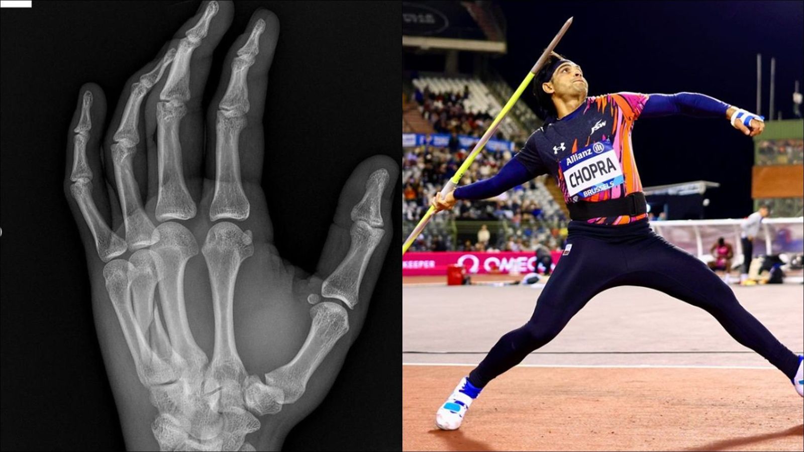 'On Monday, I injured myself in practice': Runner-up Neeraj Chopra reveals he competed in Diamond League final with fractured hand Neeraj Chopra's fractured left hand's X-ray (left) (Neeraj's Instagram)