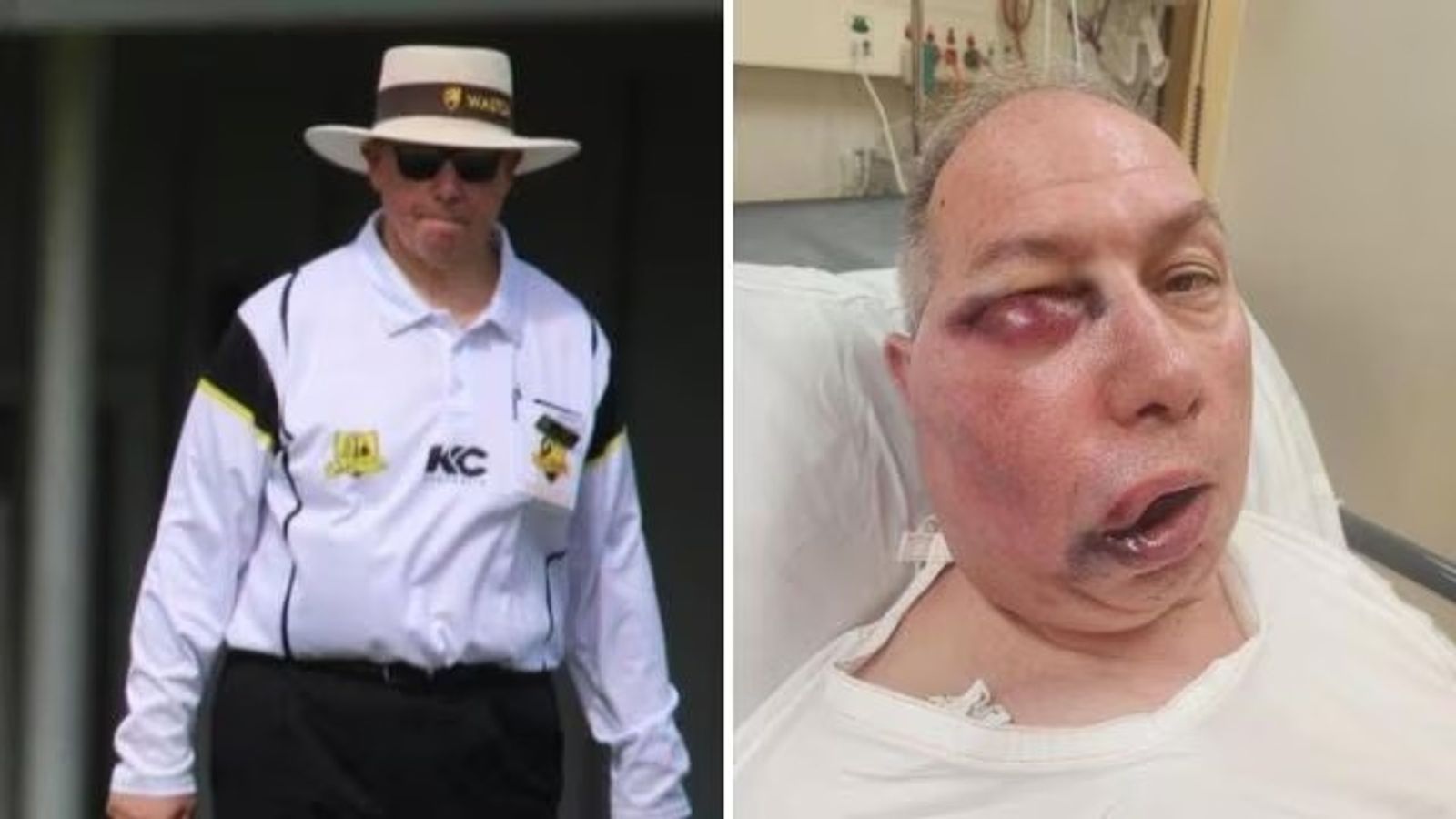 Australian umpire hospitalised after nasty blow to face while officiating in Perth, reignites debate on whether umpires should wear helmets Umpire Tony DeNobrega hospitalised after getting hit on the face.