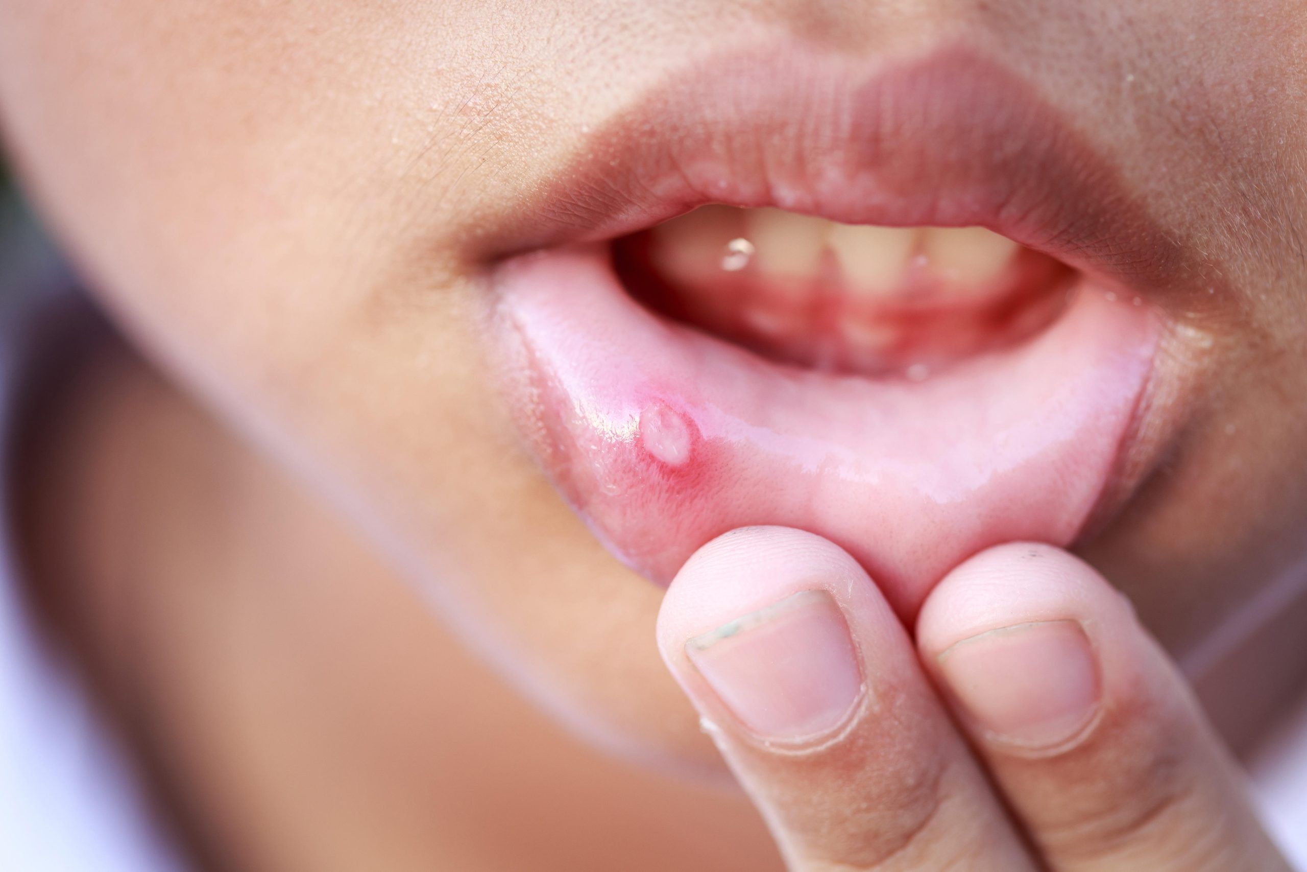 mouth sores and ulcers 5e0c8e