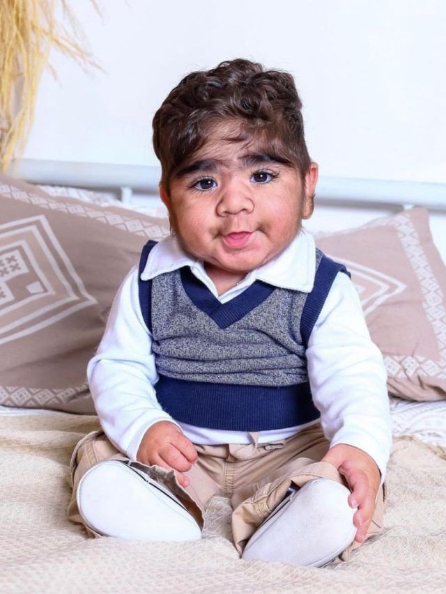 दाढ़ी मूंछों वाला बच्चा, दुनियाभर में हो रही चर्चा, जानें वजह