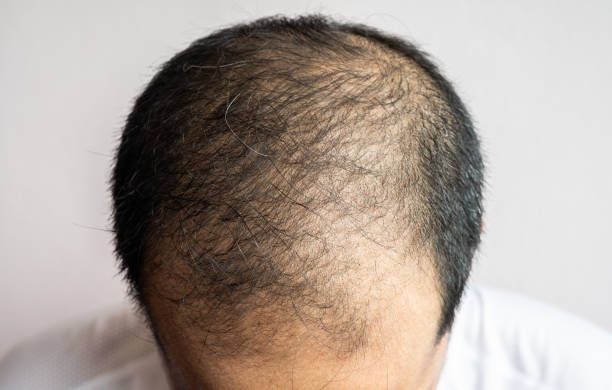 hair loss 3