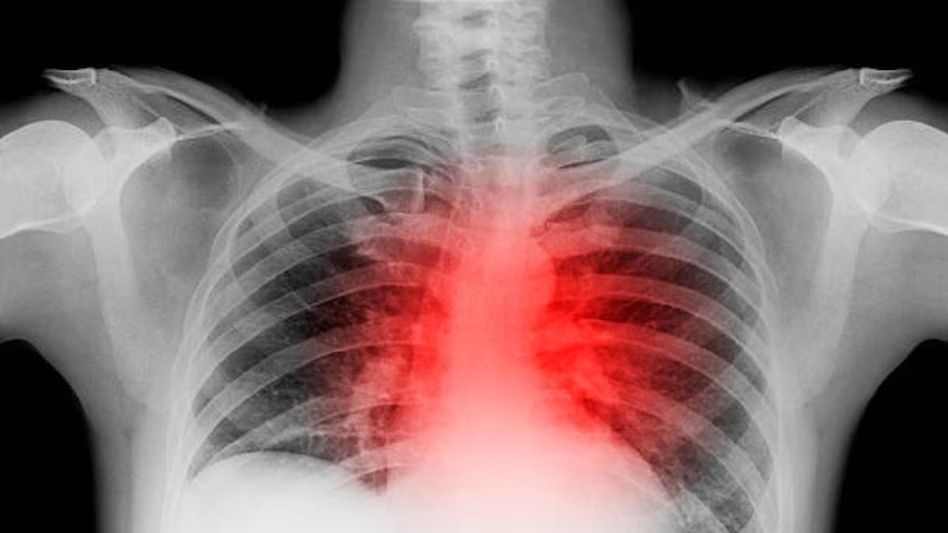 lung887878787