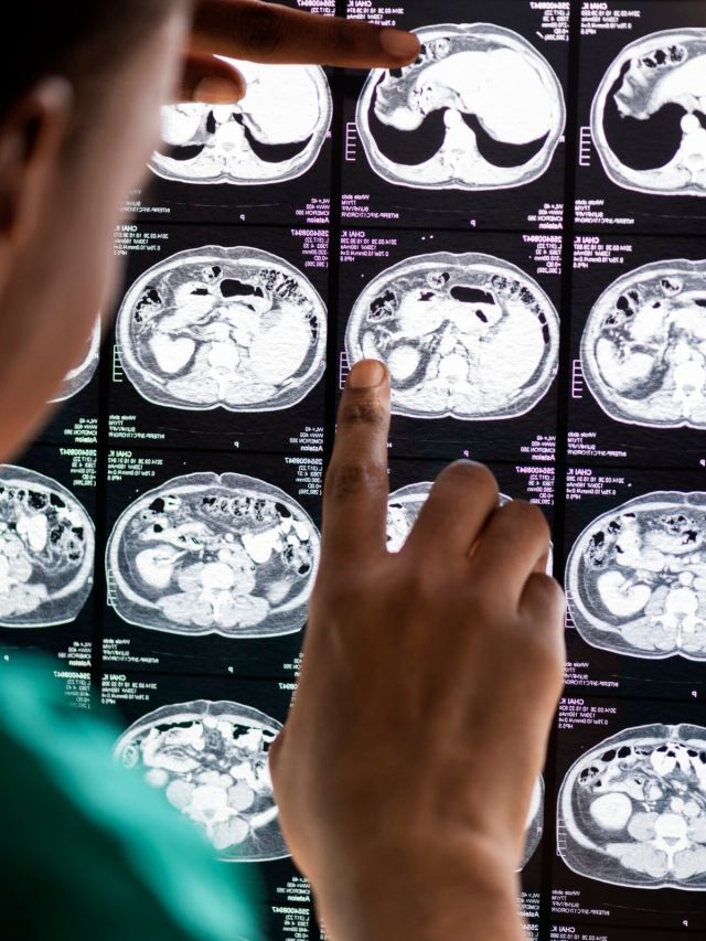 Can Viagra lower the risk of Alzheimer disease in men? Here is what the new study shows