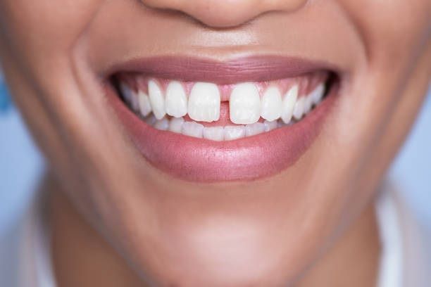 भाग्यवान लोगों के होते हैं ऐसे दांत, जीवन भर रहते हैं धनवान - Samudra shastra says those who has gap on teeth get success in life earn money always stays rich tviss